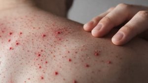 Confirman caso de sarampión en Puerto Escondido ante alerta epidemiológica nacional